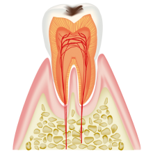 最表面の虫歯（C1）