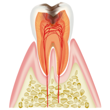 神経まで達した虫歯（C3）