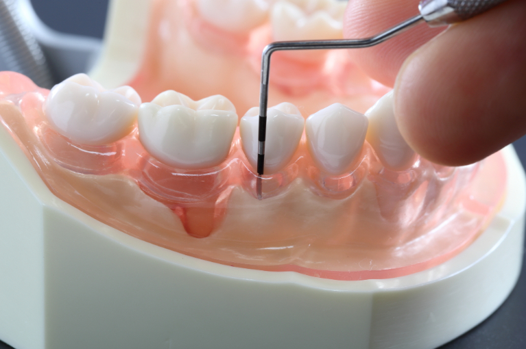 歯のクリーニング、歯石とり、歯石除去のポイント5